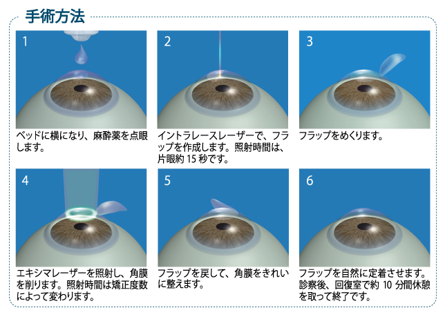 ”レーシックの手術方法” ”手術方法”