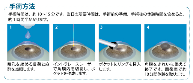 ”アキュフォーカスリングの手術方法” ”手術方法”
