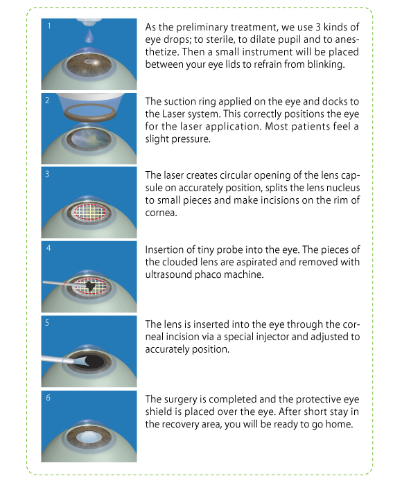 cataracy surgery procedure