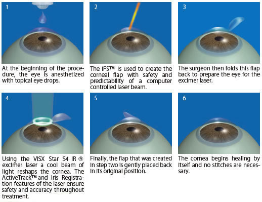 iLASIK® Surgical Procedure