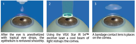 PRK Surgical Procedure