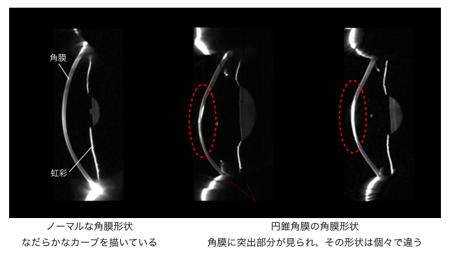 円錐角膜の角膜形状