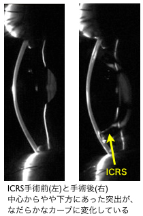 ICRS手術前手術後
