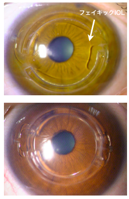 ICRSとフェイキックIOLの組み合わせ
