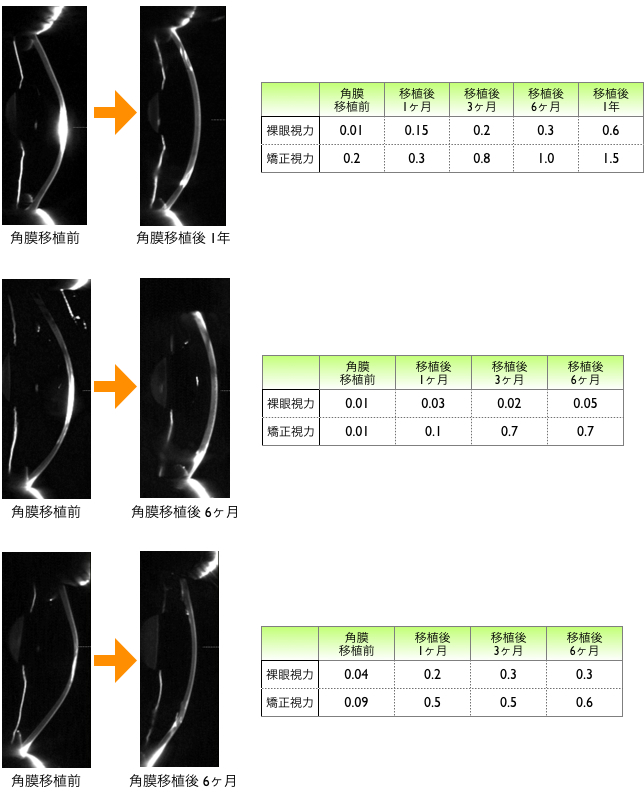 ”角膜移植手術後の経過の一例”
