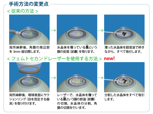 白内障手術 白内障手術の方法 レーシックのみなとみらいアイクリニック