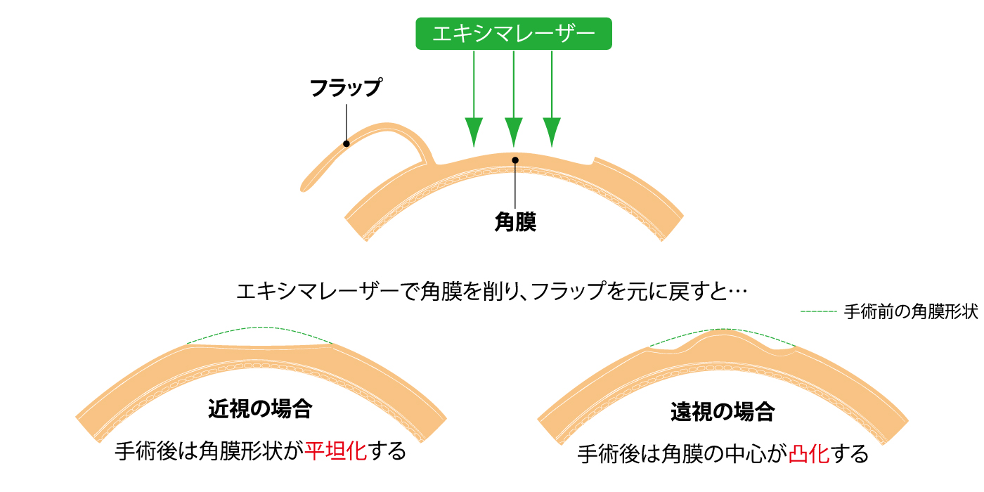 レーシック