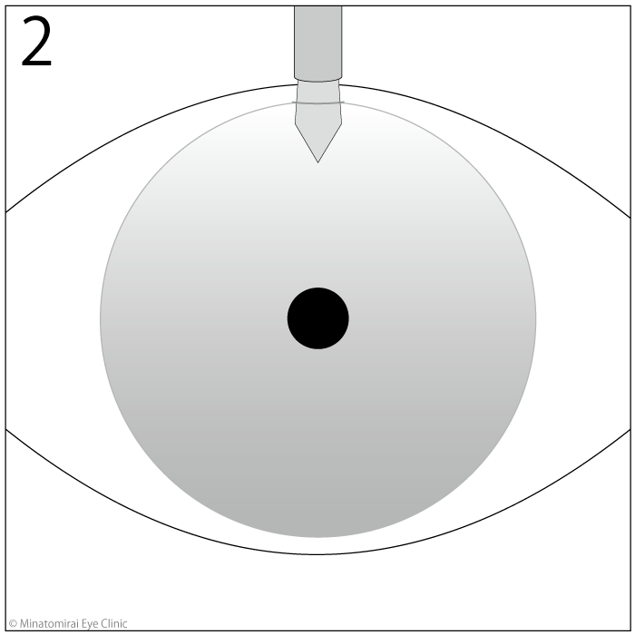 手術方法2