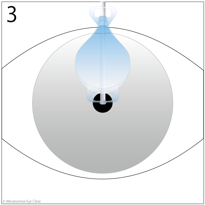 手術方法3