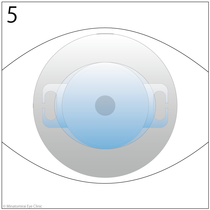 手術方法5