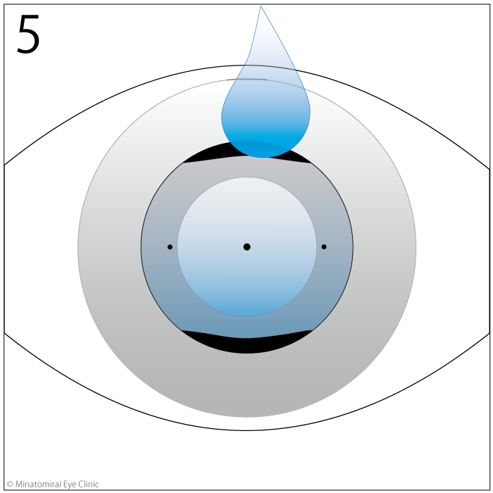 手術方法5