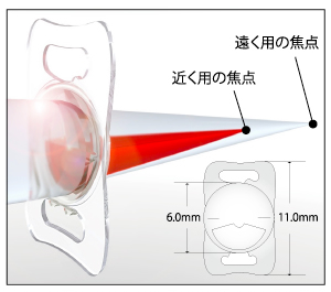 ”多焦点眼内レンズ”